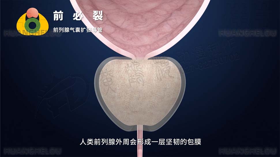 三维3d医学动画制作《经尿道前列腺气囊扩张导管术》手术演示动画片01.jpg