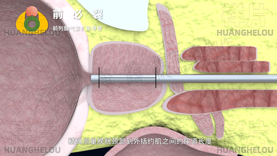 三维3d医学动画制作《经尿道前列腺气囊扩张导管术》手术演示动画片05.jpg