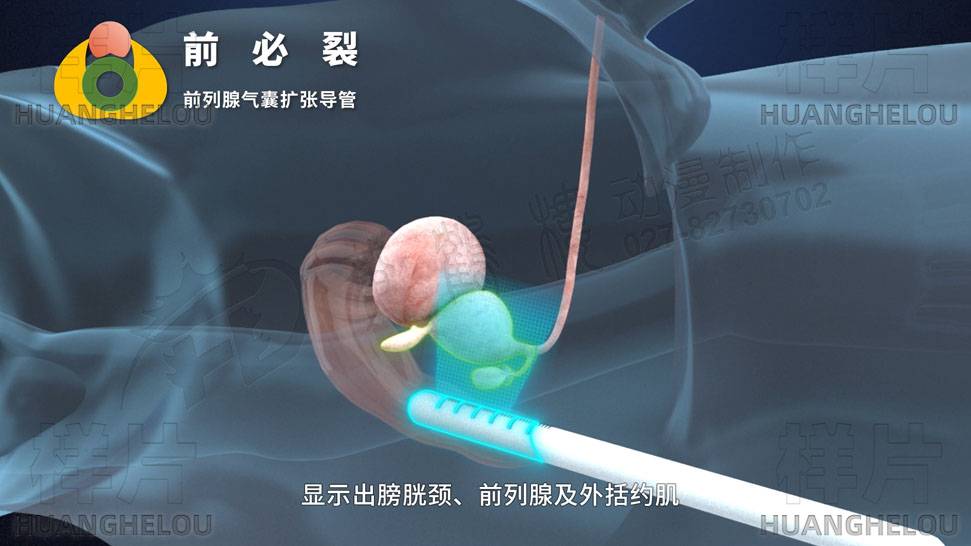 三维3d医学动画制作《经尿道前列腺气囊扩张导管术》手术演示动画片06.jpg