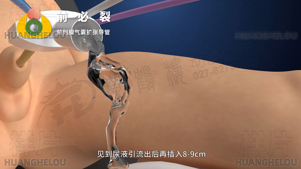 三维3d医学动画制作《经尿道前列腺气囊扩张导管术》手术演示动画片08.jpg