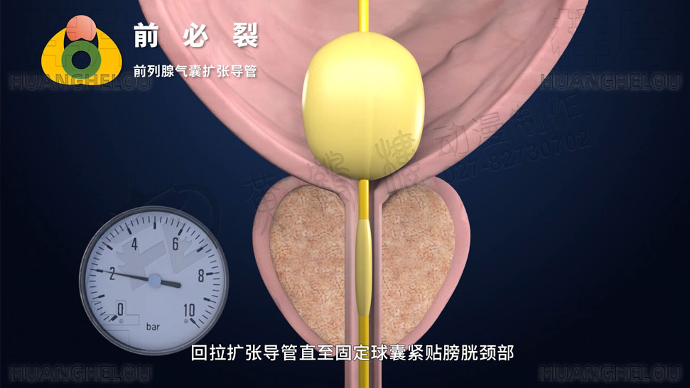 三维3d医学动画制作《经尿道前列腺气囊扩张导管术》手术演示动画片09.jpg