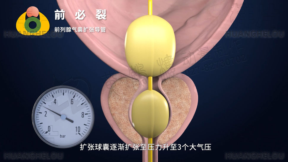 三维3d医学动画制作《经尿道前列腺气囊扩张导管术》手术演示动画片10.jpg