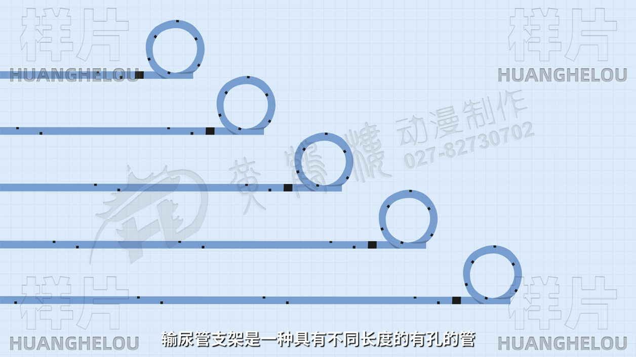 手绘医疗动漫制作《输尿管支架》MG动画科普短视频